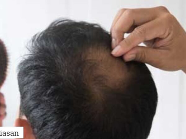 Rambut Gugur Teruk? Ini Antara Punca Yang Ramai Tak Sedar Sampai Jadi Botak!