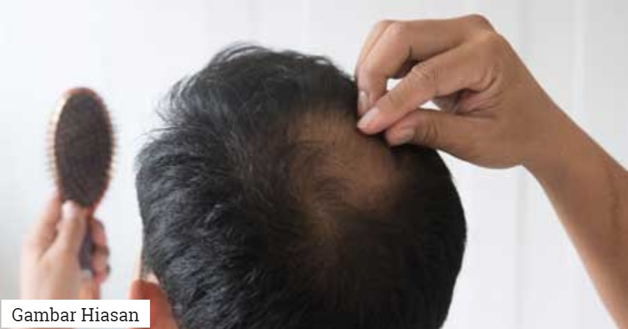 Rambut Gugur Teruk? Ini Antara Punca Yang Ramai Tak Sedar Sampai Jadi Botak!