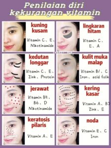 Kekurangan vitamin D